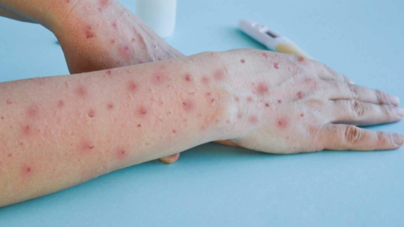 img-Mpox : le ministère de la Santé met en place un dispositif de surveillance et d’alerte